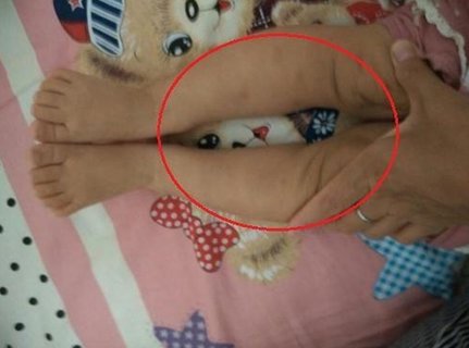 寶寶羅圈腿怎么矯正？寶寶羅圈腿最佳矯正方法