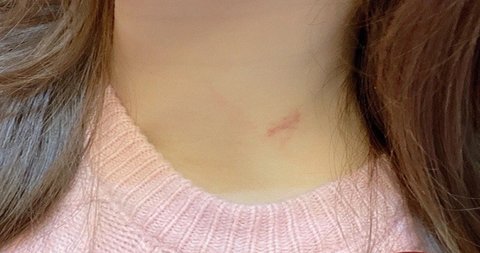 草莓印怎么在一晚消除？快速消除草莓印的方法