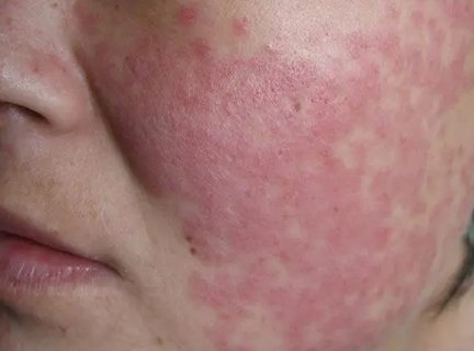 兒童紅斑狼瘡早期有什么癥狀？兒童紅斑狼瘡早期10個征兆