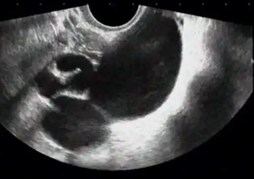 做試管要做多少次陰超？試管嬰兒陰超檢查什么時(shí)候做？