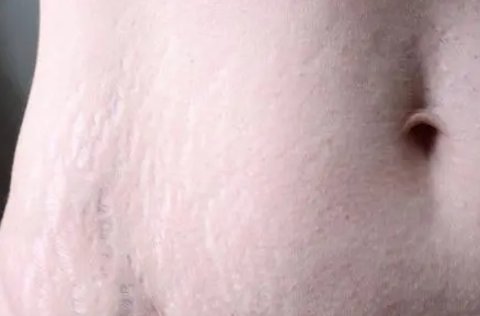 妊娠紋是什么原因引起的？避免妊娠紋的方法與技巧