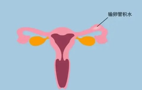 只有一側(cè)輸卵管還能正常懷孕嗎？少一根輸卵管的影響