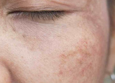 怎么樣可以淡化色斑？淡化色斑黑色素最有效的方法