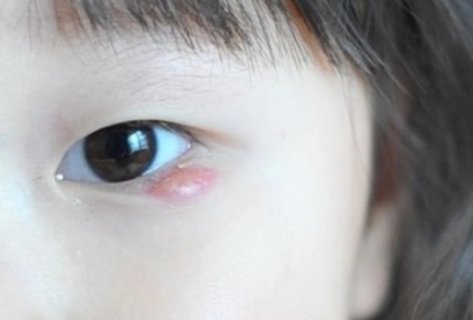 麥粒腫偏方簡單有效？家庭療法與自然緩解方法