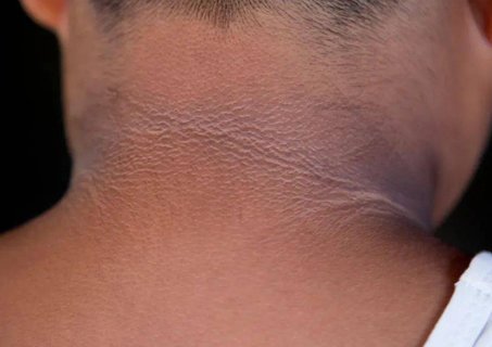 脖子腋下發(fā)黑是怎么回事？身體這兩個部位發(fā)黑建議去查查