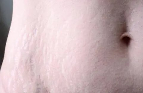 妊娠紋好幾年了怎么淡化去除？多年的妊娠紋去除最好的辦法
