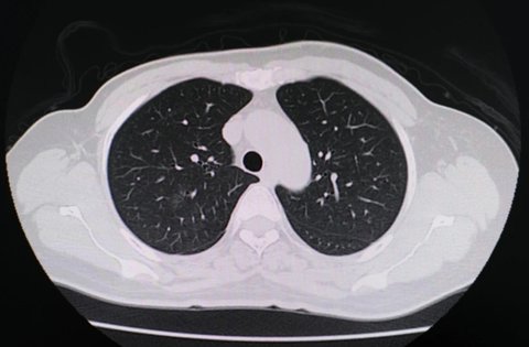 白肺病的癥狀是什么表現(xiàn)？白肺病的癥狀和前兆