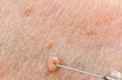 傳染性軟疣會(huì)自行消退嗎？傳染性軟疣的自愈方法