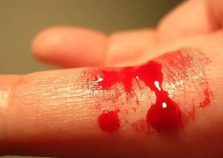 血友病做試管嬰兒會遺傳嗎？遺傳風(fēng)險及預(yù)防策略