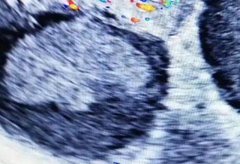 陰超最早幾天查到孕囊？懷孕跡象時(shí)間一覽