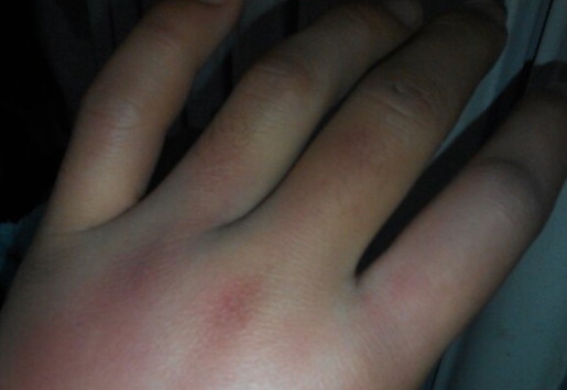 手腫是什么原因引起的？常見原因及應(yīng)對策略