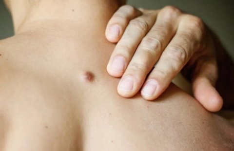 HPV感染是什么樣的？身上5種小疙瘩可能跟HPV感染有關(guān)